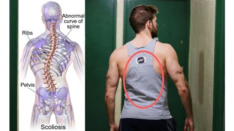 Can You Play Football With Scoliosis and Should Athletes with This Condition Pursue Competitive Sports?